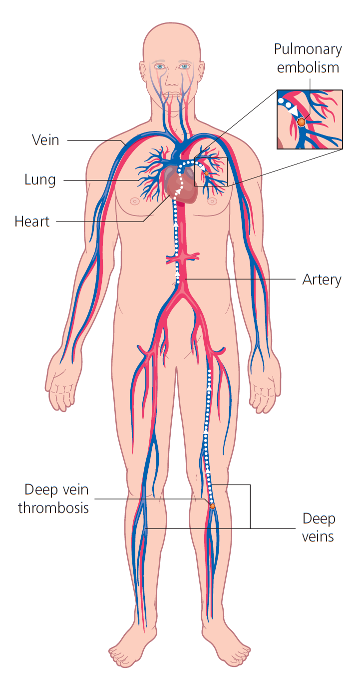 DVT