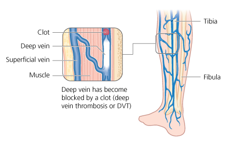 What is Thrombosis?  Deep Vein Thrombosis