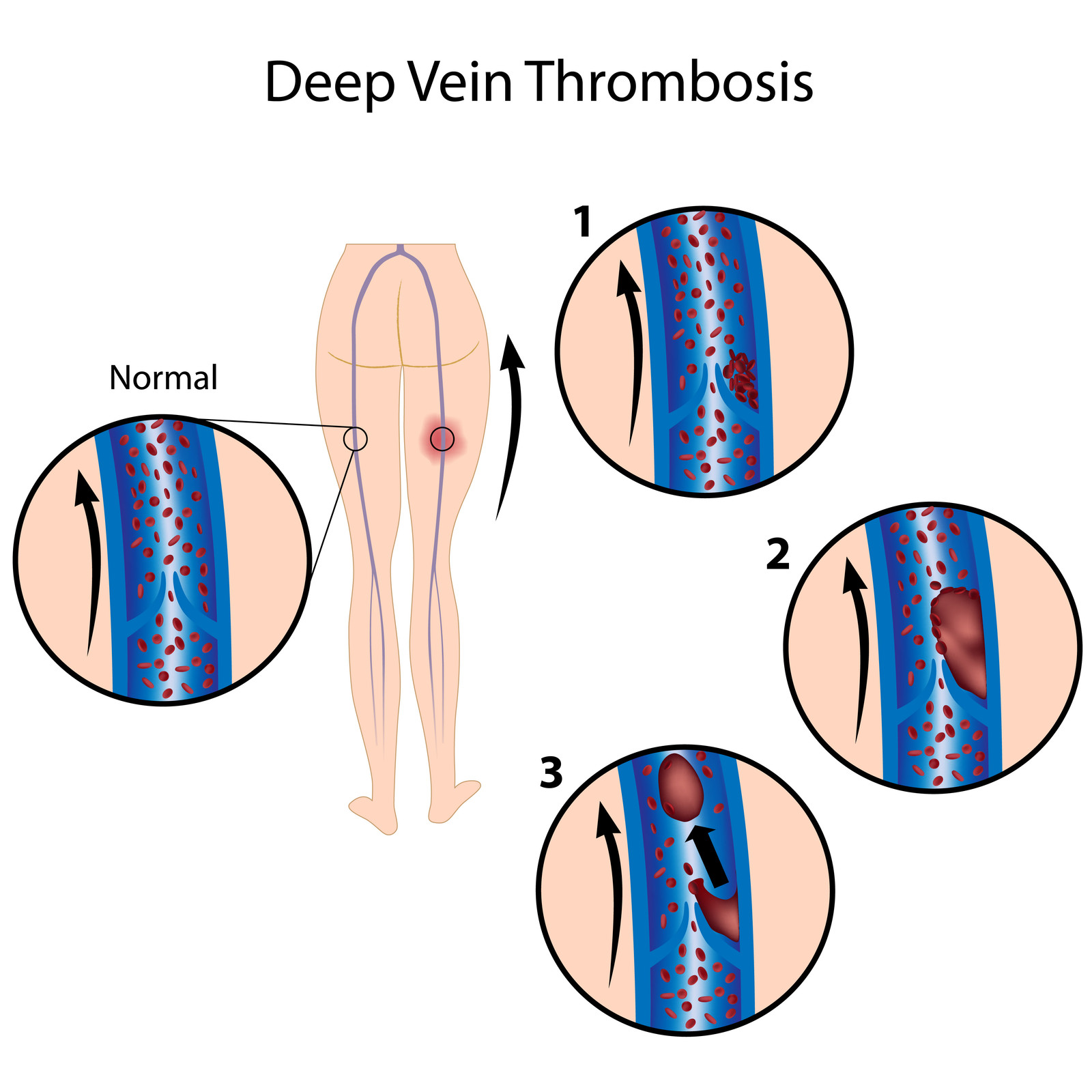 Deep Vein Thrombosis