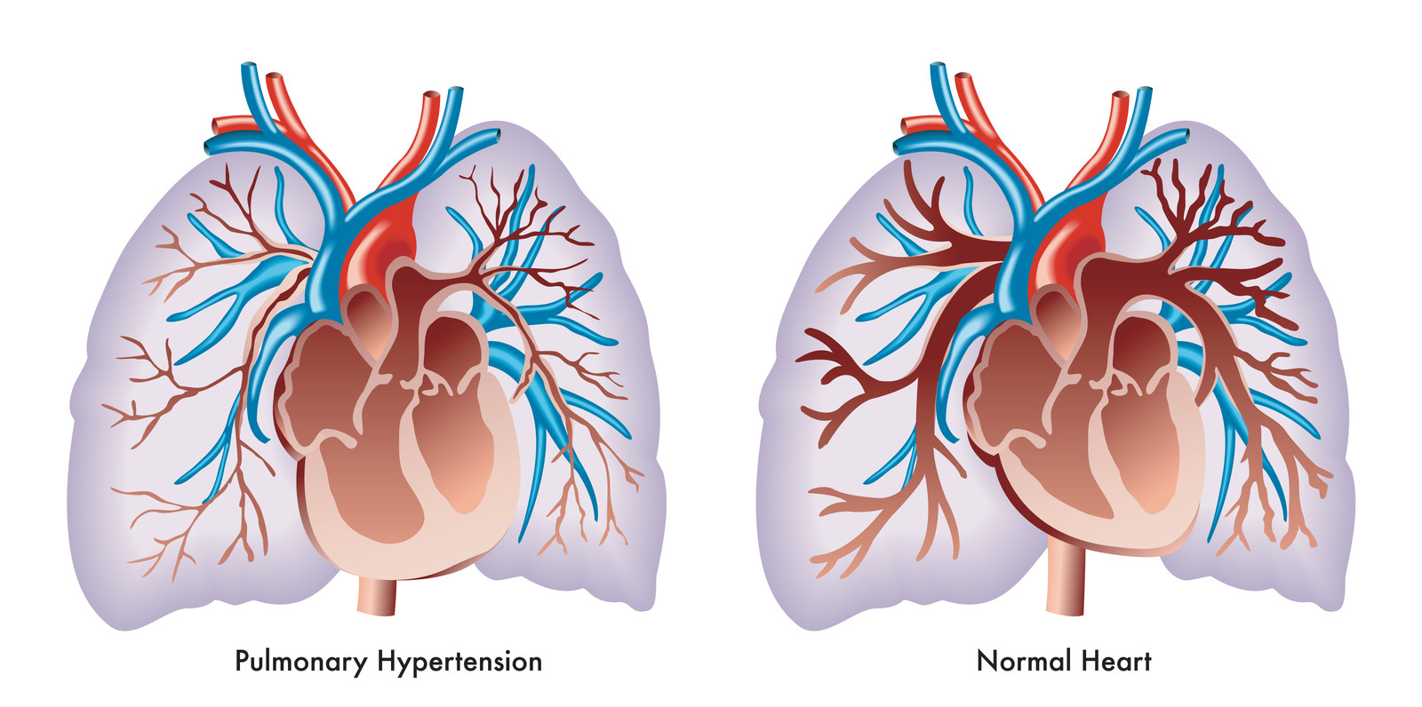 Comparison of lungs after a pulmonary embolism